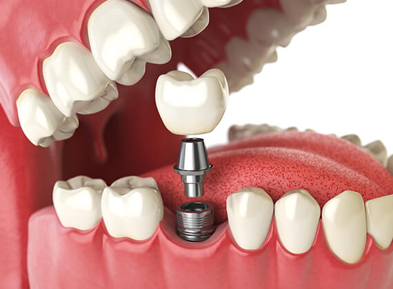 illustration of a dental implant